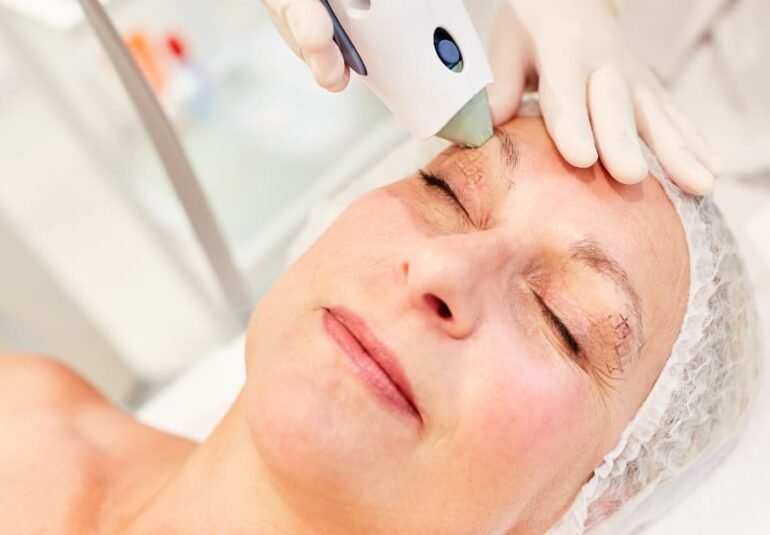 Mujer recibiendo tratamiento de rejuvenecimiento facial Thermage en una clínica estética, con dispositivo médico aplicado en la frente y párpados superiores.