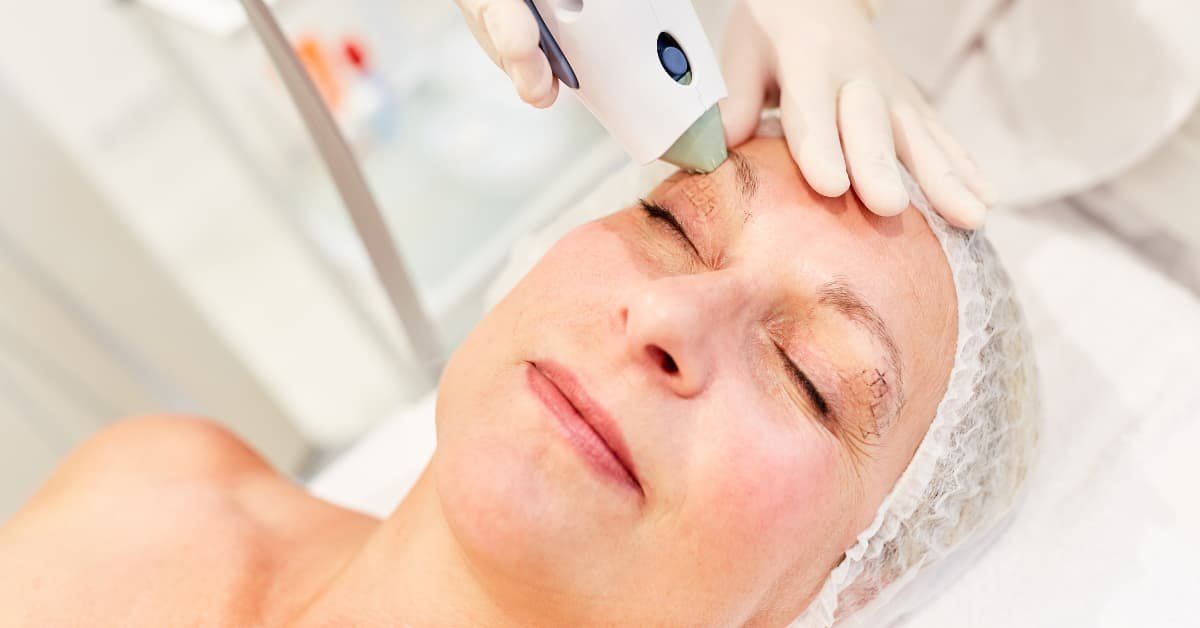 Mujer recibiendo tratamiento de rejuvenecimiento facial Thermage en una clínica estética, con dispositivo médico aplicado en la frente y párpados superiores.