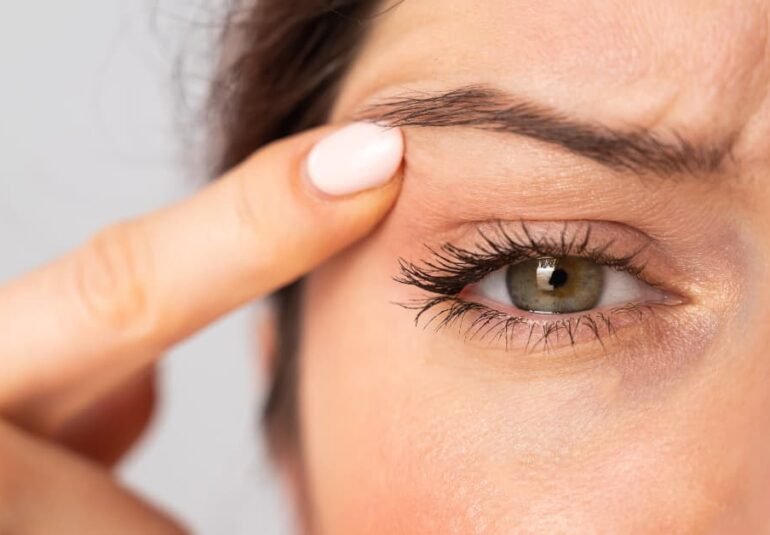 Mujer mostrando flacidez en el párpado superior, antes de someterse a una blefaroplastia sin cirugía.
