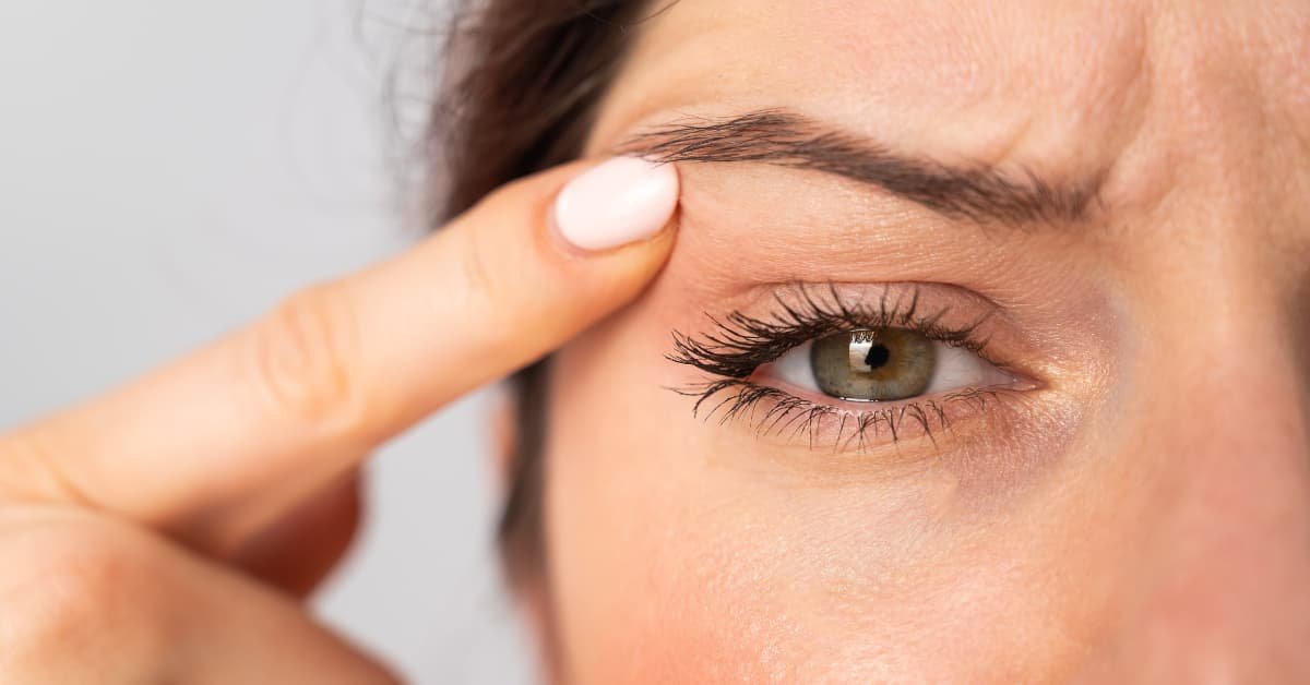 Mujer mostrando flacidez en el párpado superior, antes de someterse a una blefaroplastia sin cirugía.